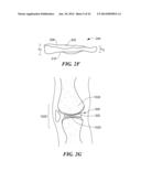 Patient Selectable Knee Arthroplasty Devices diagram and image