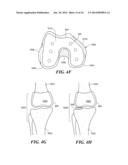 Patient Selectable Knee Arthroplasty Devices diagram and image