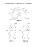 Patient Selectable Knee Arthroplasty Devices diagram and image