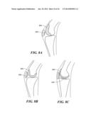 Patient Selectable Knee Arthroplasty Devices diagram and image