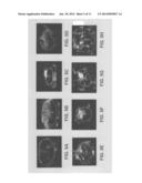 TUMOR CLASSIFICATION BASED ON AN ANALYSIS OF A RELATED ULTRASONIC     ATTENUATION MAP diagram and image