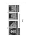 INJECTION PARADIGM FOR ADMINISTRATION OF BOTULINUM TOXINS diagram and image