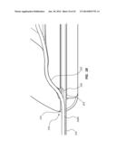 Catheter Placement Device and Method diagram and image