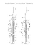 Catheter Placement Device and Method diagram and image