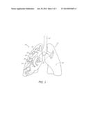 BRONCHOSCOPIC REPAIR OF AIR LEAKS IN A LUNG diagram and image