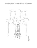 BONE STABILIZATION MEMBER WITH BONE SCREW RETENTION MECHANISM diagram and image