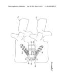 BONE STABILIZATION MEMBER WITH BONE SCREW RETENTION MECHANISM diagram and image