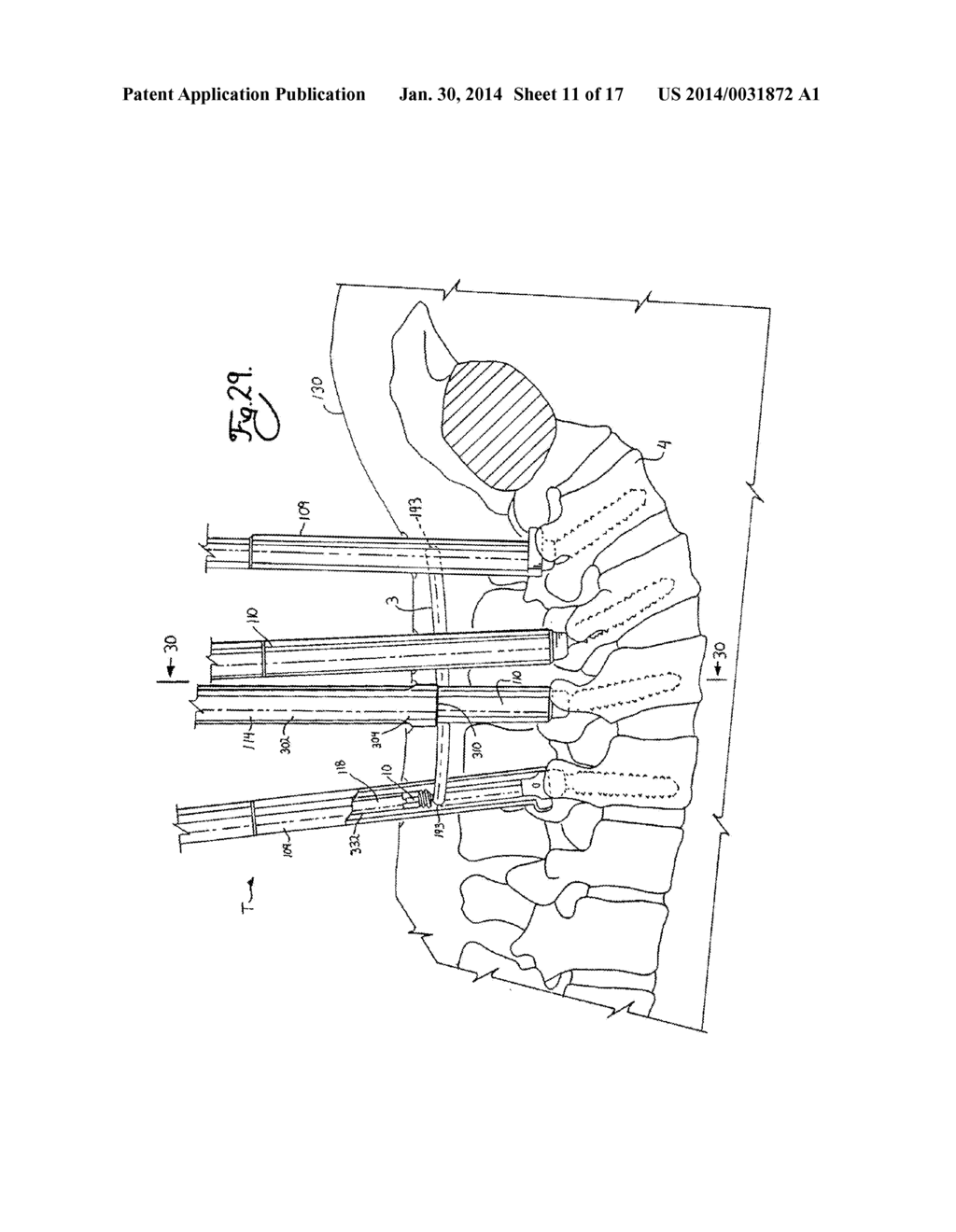 SPINAL FIXATION TOOL SET AND METHOD - diagram, schematic, and image 12