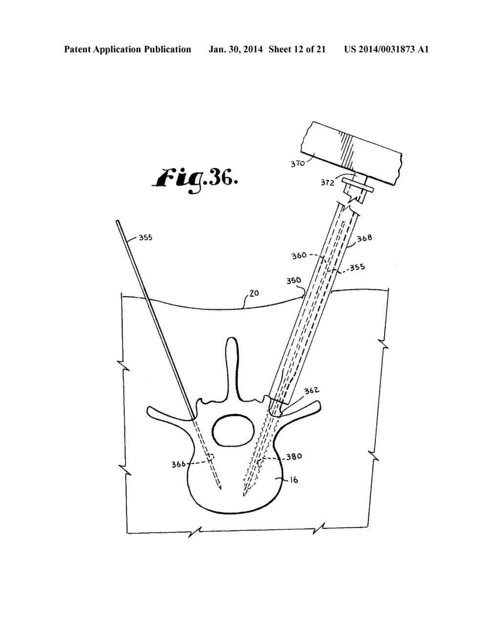 Spinal fixation tool set and method - diagram, schematic, and image 13