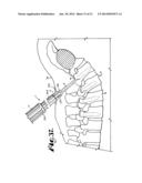 Spinal fixation tool set and method diagram and image