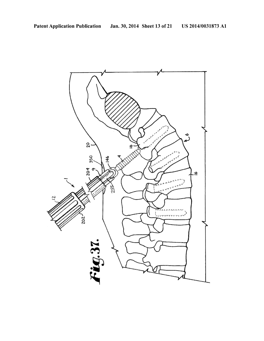 Spinal fixation tool set and method - diagram, schematic, and image 14