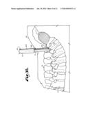 Spinal fixation tool set and method diagram and image