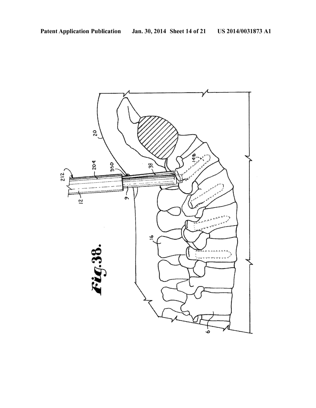 Spinal fixation tool set and method - diagram, schematic, and image 15