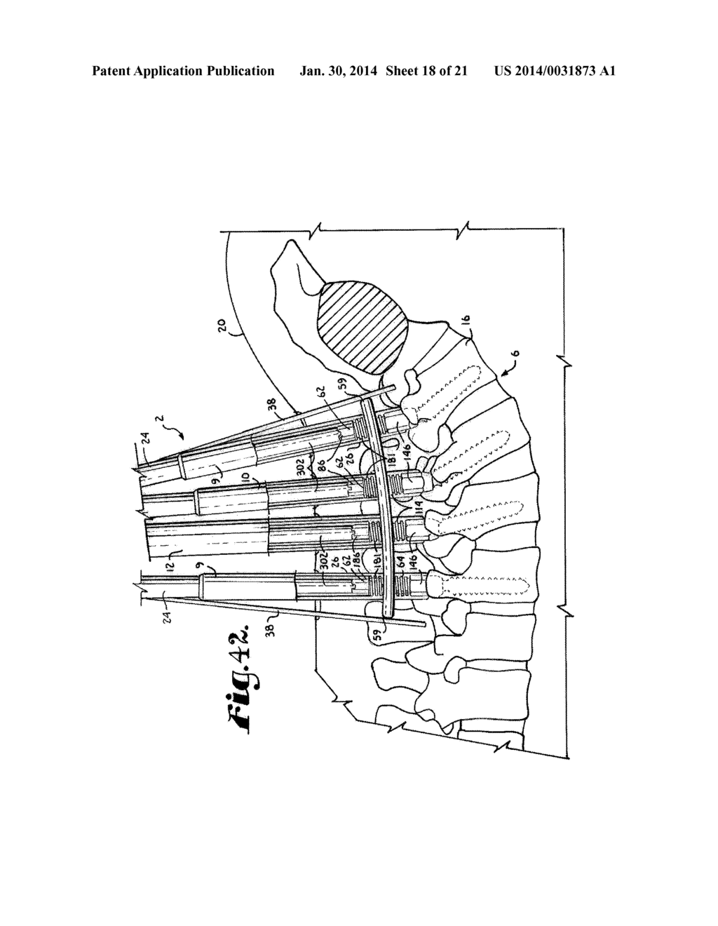 Spinal fixation tool set and method - diagram, schematic, and image 19