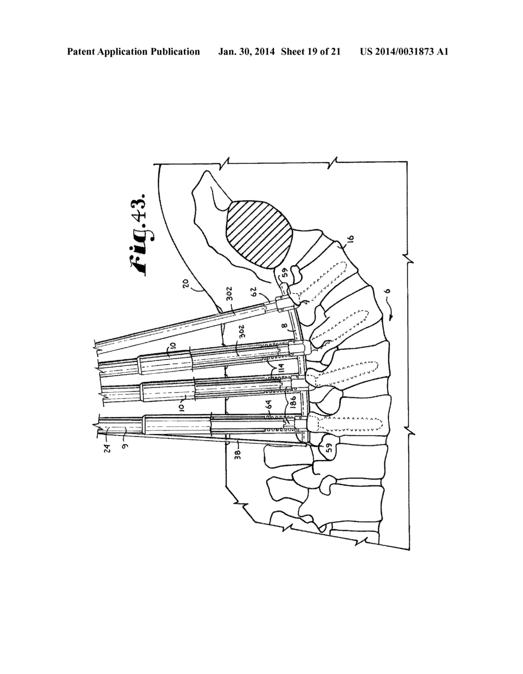 Spinal fixation tool set and method - diagram, schematic, and image 20