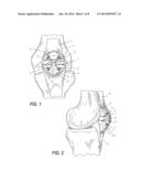 LOW PROFILE PERIARTIULAR TENSION BAND PLATING SYSTEM WITH SOFT TISSUE     NEUTRALIZATION CABLE TUNNEL/CHANNEL FOR USE ON THE OLECRANON diagram and image