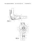 LOW PROFILE PERIARTIULAR TENSION BAND PLATING SYSTEM WITH SOFT TISSUE     NEUTRALIZATION CABLE TUNNEL/CHANNEL FOR USE ON THE OLECRANON diagram and image