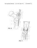 LOW PROFILE PERIARTIULAR TENSION BAND PLATING SYSTEM WITH SOFT TISSUE     NEUTRALIZATION CABLE TUNNEL/CHANNEL FOR USE ON THE OLECRANON diagram and image