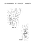 LOW PROFILE PERIARTIULAR TENSION BAND PLATING SYSTEM WITH SOFT TISSUE     NEUTRALIZATION CABLE TUNNEL/CHANNEL FOR USE ON THE OLECRANON diagram and image