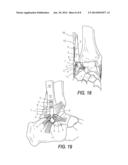 LOW PROFILE PERIARTIULAR TENSION BAND PLATING SYSTEM WITH SOFT TISSUE     NEUTRALIZATION CABLE TUNNEL/CHANNEL FOR USE ON THE OLECRANON diagram and image