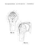 LOW PROFILE PERIARTIULAR TENSION BAND PLATING SYSTEM WITH SOFT TISSUE     NEUTRALIZATION CABLE TUNNEL/CHANNEL FOR USE ON THE GREATER TUBEROSITY OF     THE HUMERUS diagram and image