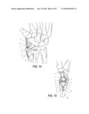 LOW PROFILE PERIARTIULAR TENSION BAND PLATING SYSTEM WITH SOFT TISSUE     NEUTRALIZATION CABLE TUNNEL/CHANNEL FOR USE ON THE GREATER TUBEROSITY OF     THE HUMERUS diagram and image