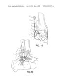 LOW PROFILE PERIARTIULAR TENSION BAND PLATING SYSTEM WITH SOFT TISSUE     NEUTRALIZATION CABLE TUNNEL/CHANNEL FOR USE ON THE GREATER TUBEROSITY OF     THE HUMERUS diagram and image