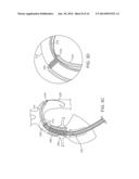 Delivery Catheter With Distal Moving Capsule for Transapical Prosthetic     Heart Valve Delivery diagram and image