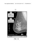 Displaying Computer-Aided Detection Information With Associated Breast     Tomosynthesis Image Information diagram and image