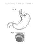 BARIATRIC INSTRUCMENT OR ACCESSORY WITH SENSORS diagram and image