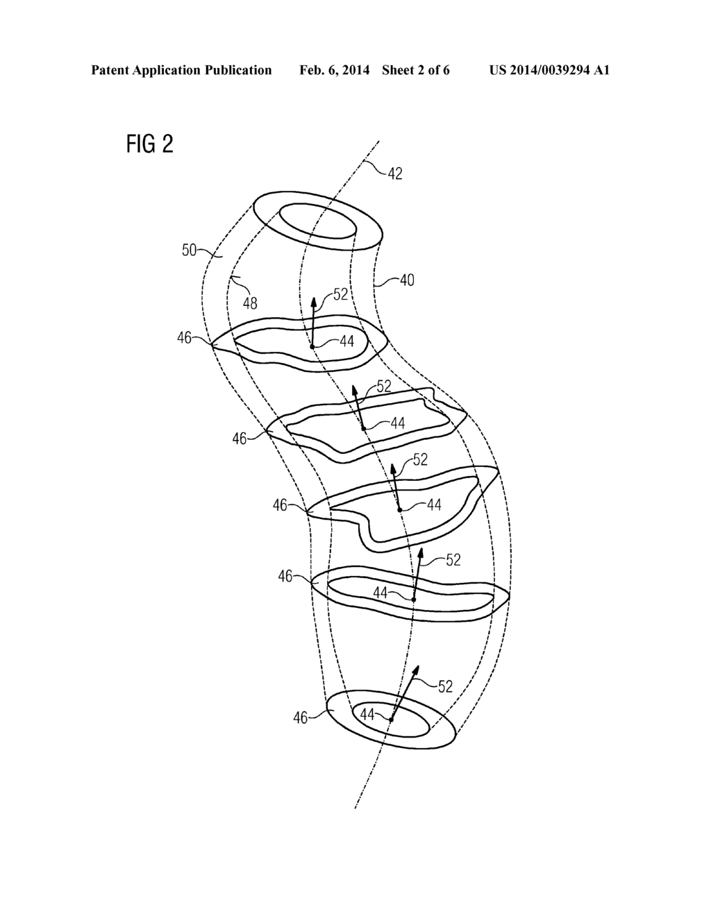 CATHETER WITH ULTRASOUND SENSOR AND METHOD FOR CREATING A VOLUME GRAPHIC     BY MEANS OF THE CATHETER - diagram, schematic, and image 03