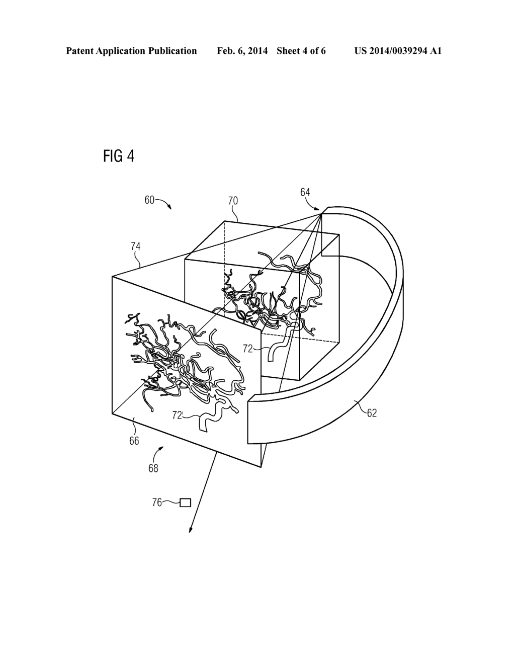 CATHETER WITH ULTRASOUND SENSOR AND METHOD FOR CREATING A VOLUME GRAPHIC     BY MEANS OF THE CATHETER - diagram, schematic, and image 05