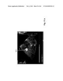 ULTRASONIC SYSTEM FOR ASSESSING TISSUE SUBSTANCE EXTRACTION diagram and image