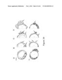 ULTRASONIC SYSTEM FOR ASSESSING TISSUE SUBSTANCE EXTRACTION diagram and image