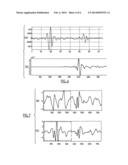 DEVICE FOR THE ANALYSIS OF AN ENDOCARDIAC SIGNAL OF ACCELERATION diagram and image