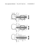 APPARATUS AND METHOD FOR DELIVERING AN EMBOLIC COMPOSITION diagram and image