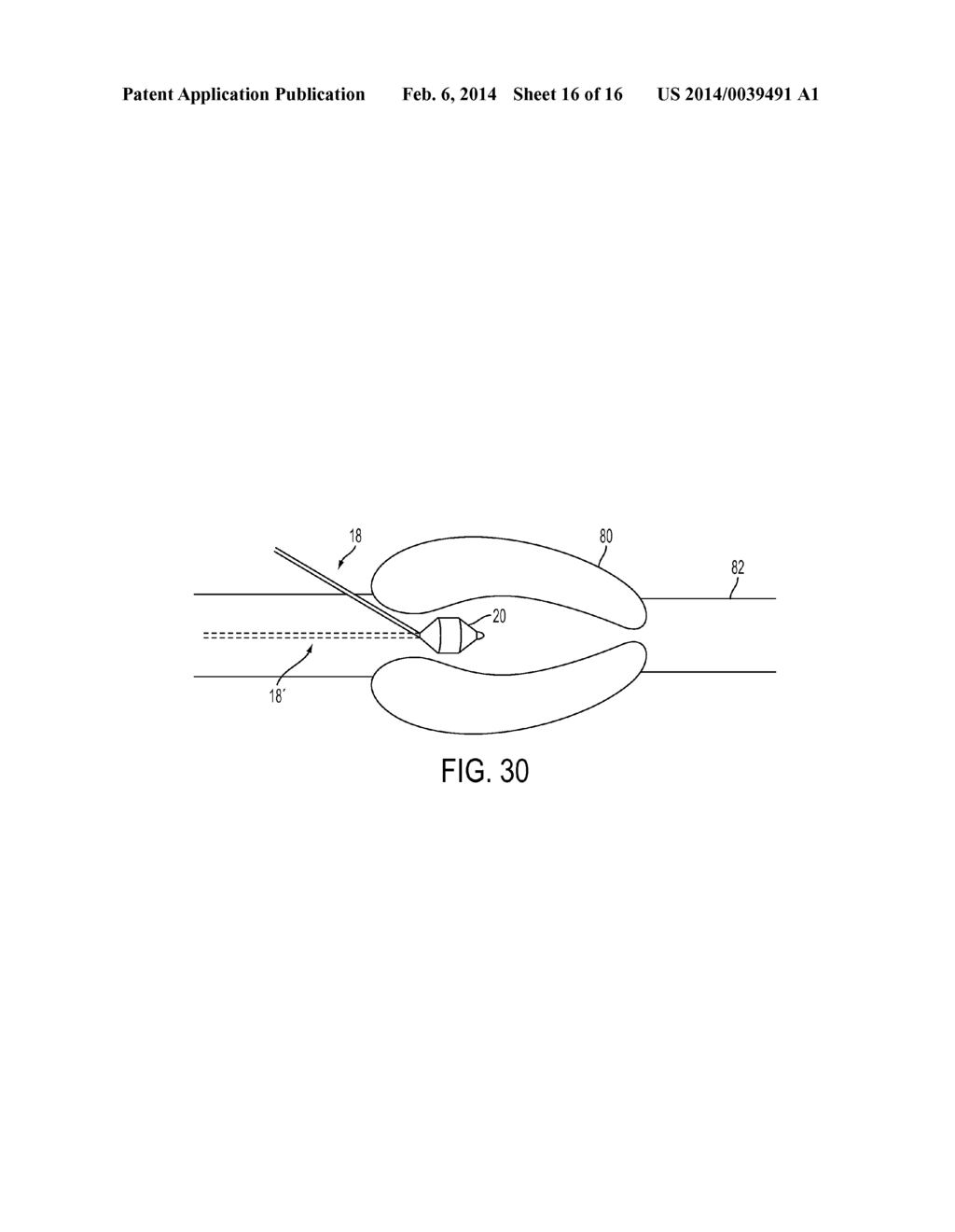 FLEXIBLE EXPANDABLE ELECTRODE AND METHOD OF INTRALUMINAL DELIVERY OF     PULSED POWER - diagram, schematic, and image 17