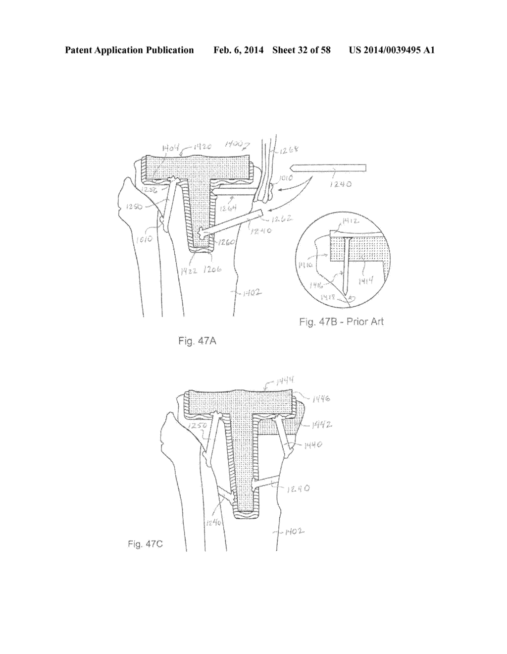 METHODS OF SECURING A FASTENER - diagram, schematic, and image 33