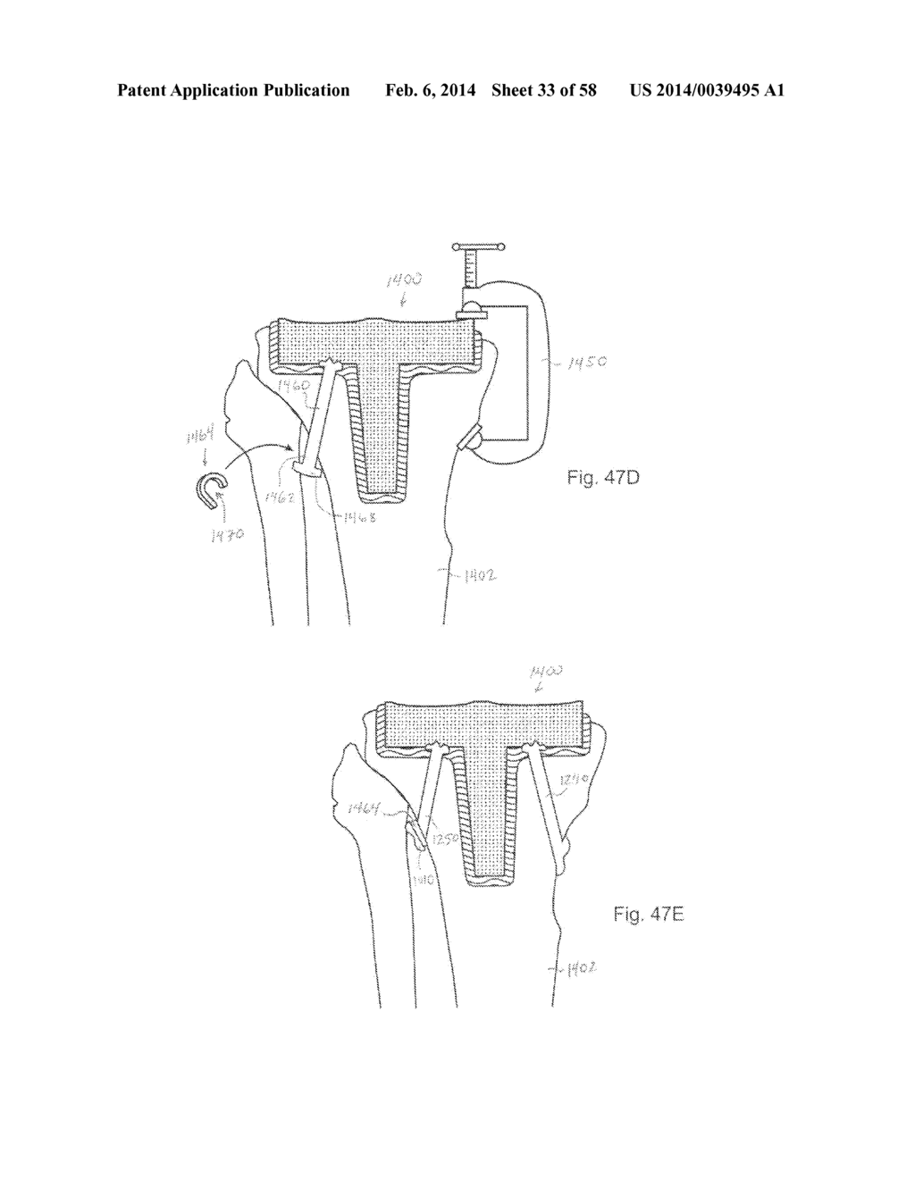 METHODS OF SECURING A FASTENER - diagram, schematic, and image 34