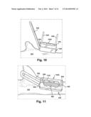 METHOD AND APPARATUS FOR PROVIDING A SOFT-TISSUE TRANSPLANT TO A RECEIVING     BONE diagram and image