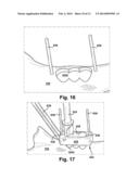 METHOD AND APPARATUS FOR PROVIDING A SOFT-TISSUE TRANSPLANT TO A RECEIVING     BONE diagram and image