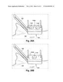 METHOD AND APPARATUS FOR PROVIDING A SOFT-TISSUE TRANSPLANT TO A RECEIVING     BONE diagram and image