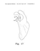 RECIPROCATING RASPS FOR USE IN AN ORTHOPAEDIC SURGICAL PROCEDURE diagram and image