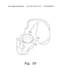 RECIPROCATING RASPS FOR USE IN AN ORTHOPAEDIC SURGICAL PROCEDURE diagram and image