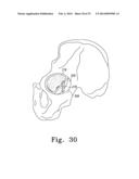 RECIPROCATING RASPS FOR USE IN AN ORTHOPAEDIC SURGICAL PROCEDURE diagram and image