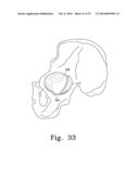 RECIPROCATING RASPS FOR USE IN AN ORTHOPAEDIC SURGICAL PROCEDURE diagram and image