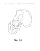 RECIPROCATING RASPS FOR USE IN AN ORTHOPAEDIC SURGICAL PROCEDURE diagram and image