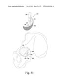 RECIPROCATING RASPS FOR USE IN AN ORTHOPAEDIC SURGICAL PROCEDURE diagram and image