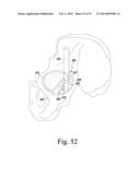 RECIPROCATING RASPS FOR USE IN AN ORTHOPAEDIC SURGICAL PROCEDURE diagram and image