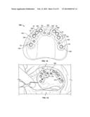 METHOD OF CREATING AN ACCURATE BONE AND SOFT-TISSUE DIGITAL DENTAL MODEL diagram and image